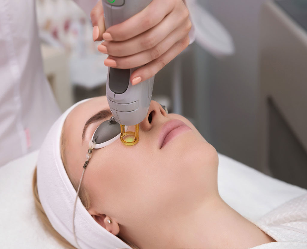 Laser Resurfacing